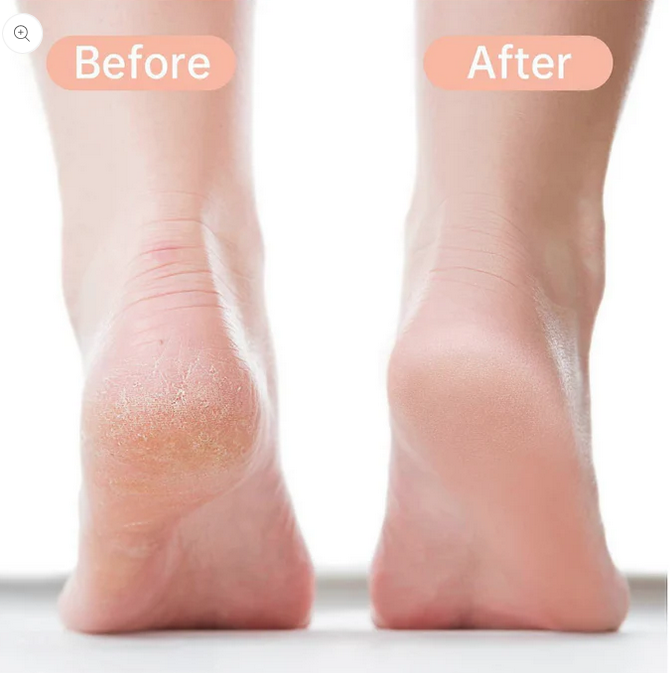 SmoothSole Pro™ Pedi-Schleifgerät